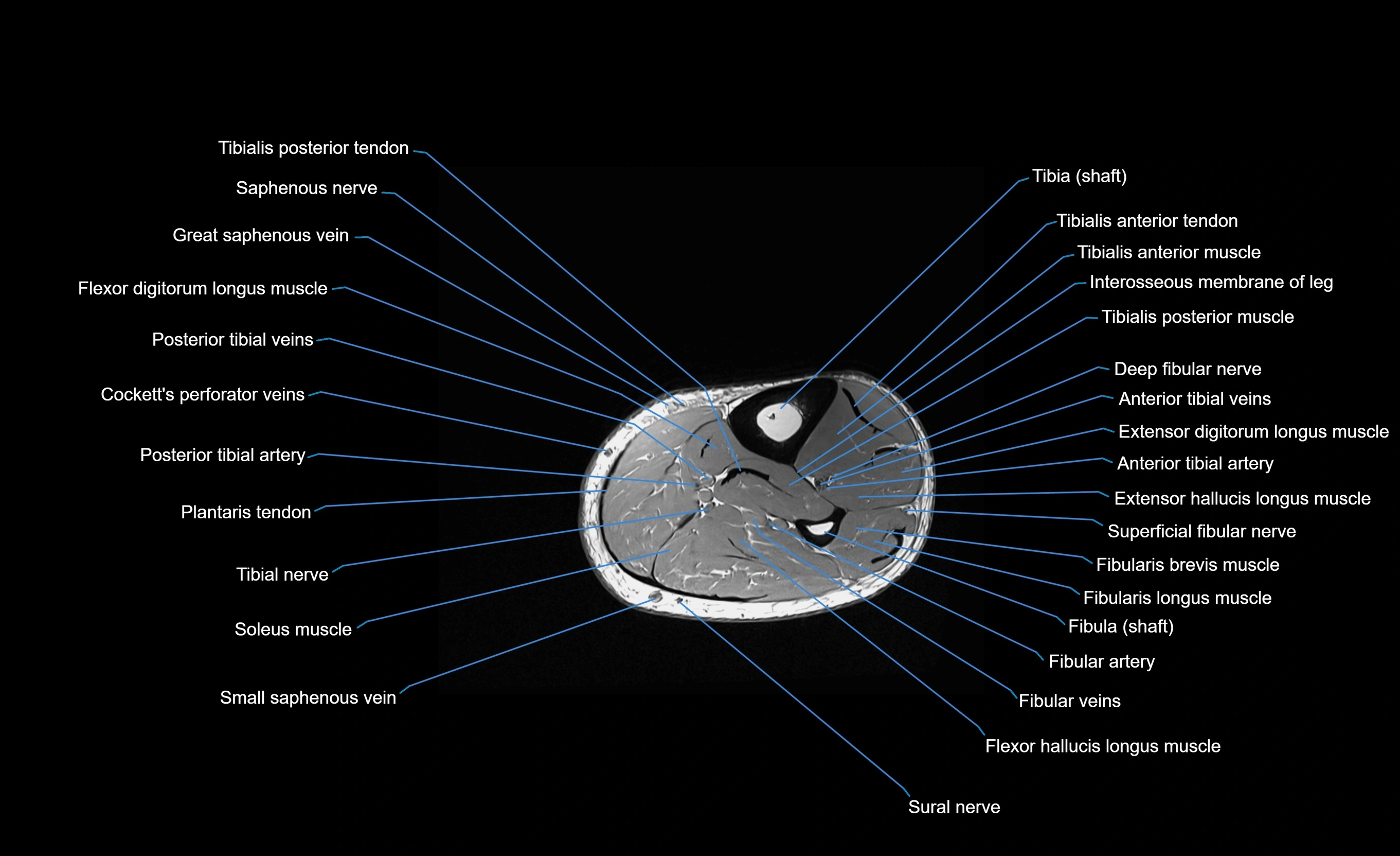 MRI lower leg axial cross sectional anatomy 3T  radiology  image-img-00001-00060.webp